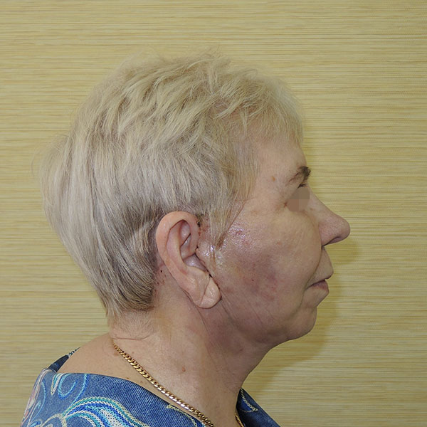 Подтяжка лица и шеи: вид после операции