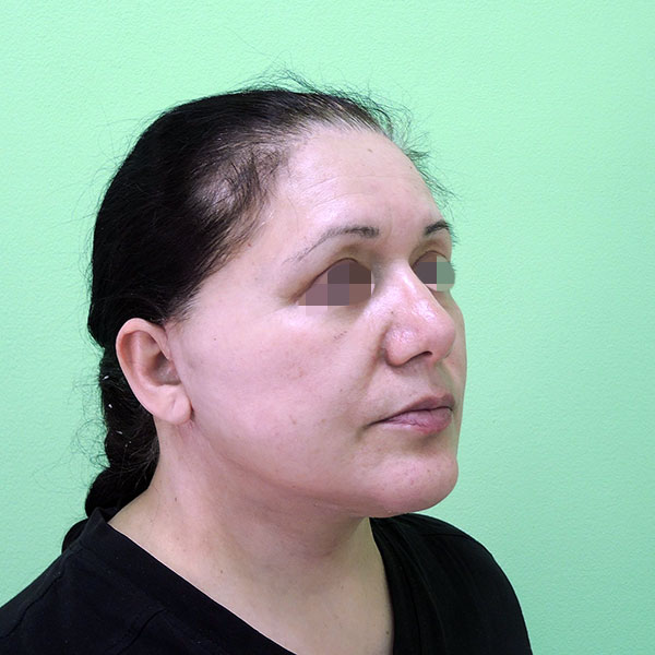Подтяжка лица и шеи: вид после операции