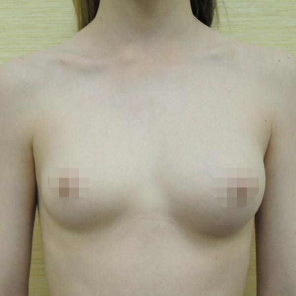 Липофилинг груди: вид перед операцией