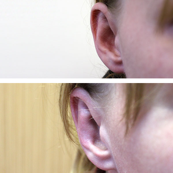 Пластика ушей: вид до- и после операции
