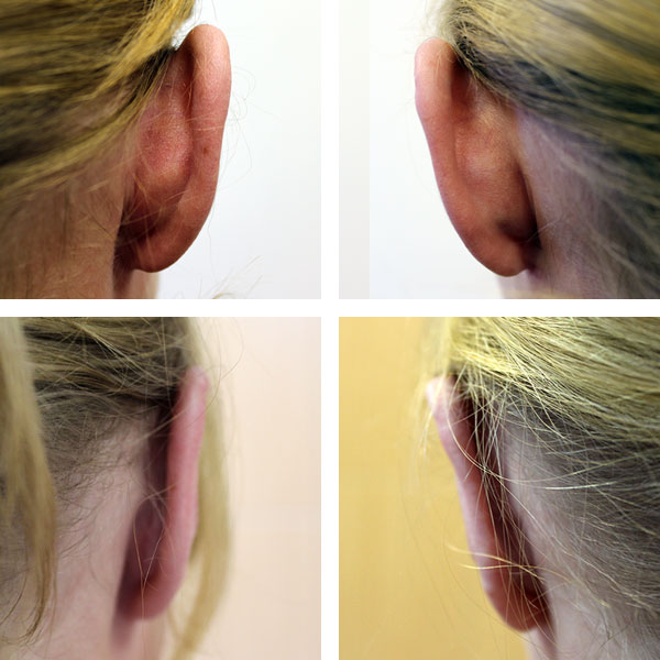 Пластика ушей: вид до- и после операции
