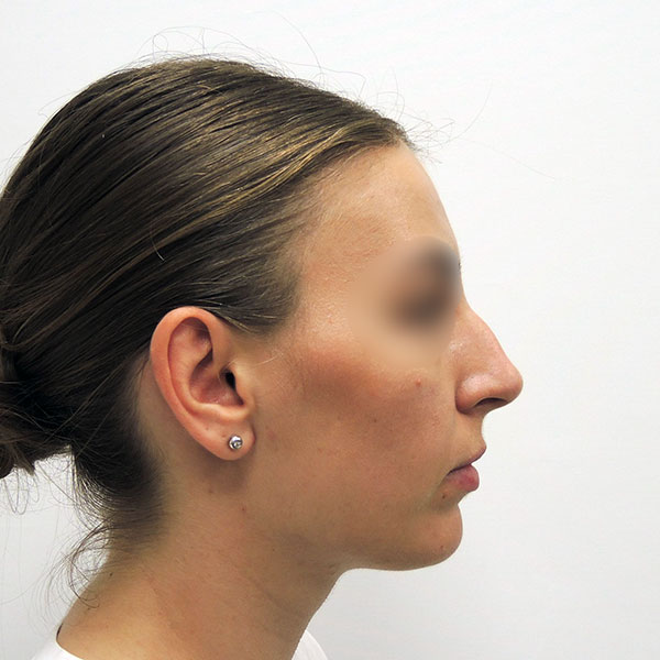 Пластика носа: вид сбоку до операции