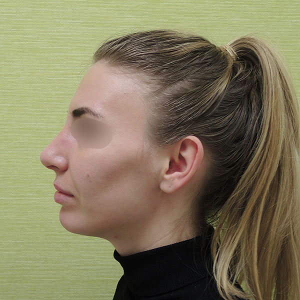 Пластика носа: вид сбоку после операции