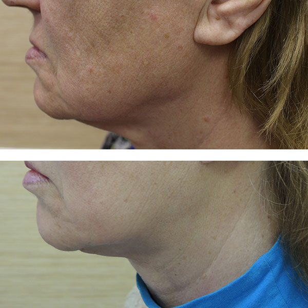 Подтяжка шеи: вид до- и после операции